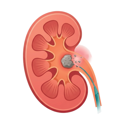 rirs treatment illustration